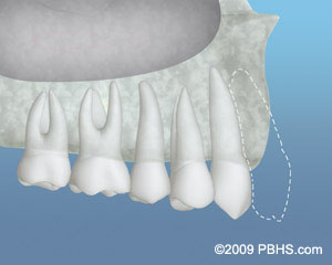 Bonegraft diagram